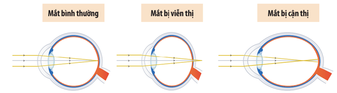 Một số tật khúc xạ ở mắt