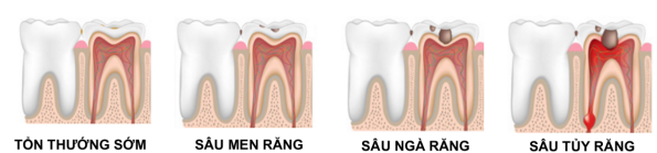 Các giai đoạn sâu răng